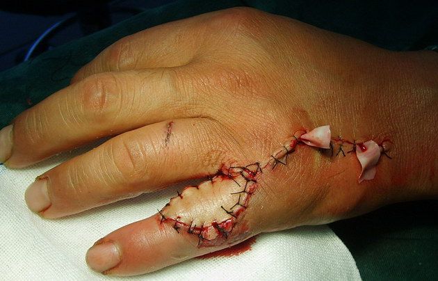 手背逆行筋膜蒂岛状皮瓣修复手指组织缺损