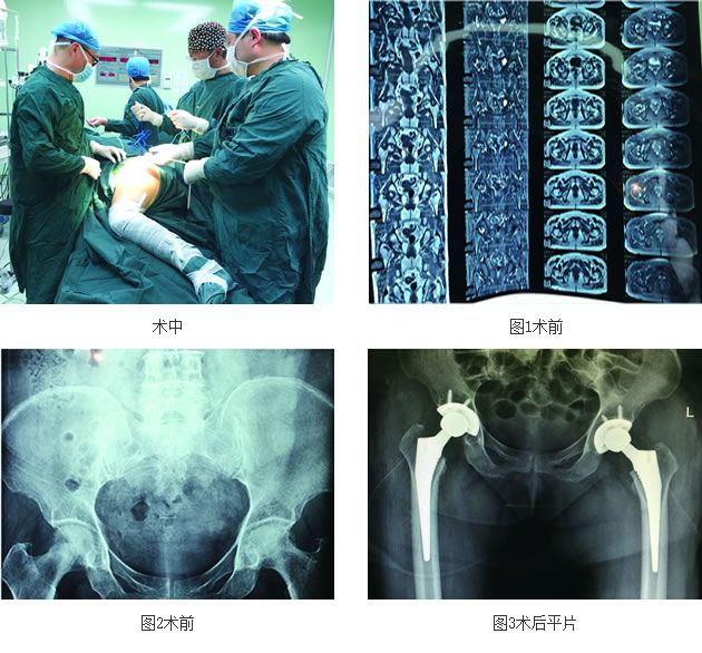 首例病例骨科三病房独立完成同期双侧全髋置换术